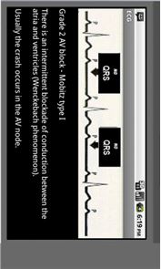 Tipos imagen Electrocardiograma ECG