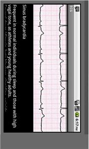 Tipos imagen Electrocardiograma ECG