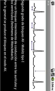 Electrocardiograma ECG Tipos image