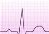 Electrocardiograma ECG Tipos